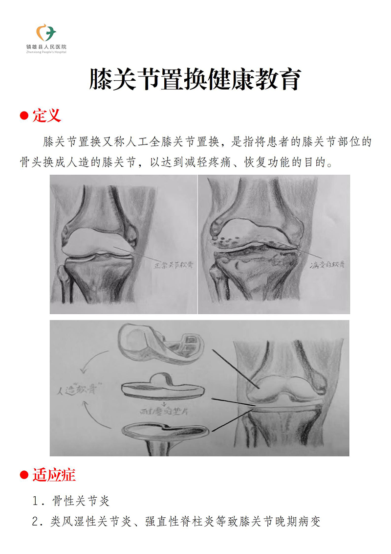 膝关节置换健康教育_01.jpg