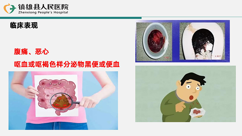 消化道出血相关疾病知识和护理常规2_08.jpg