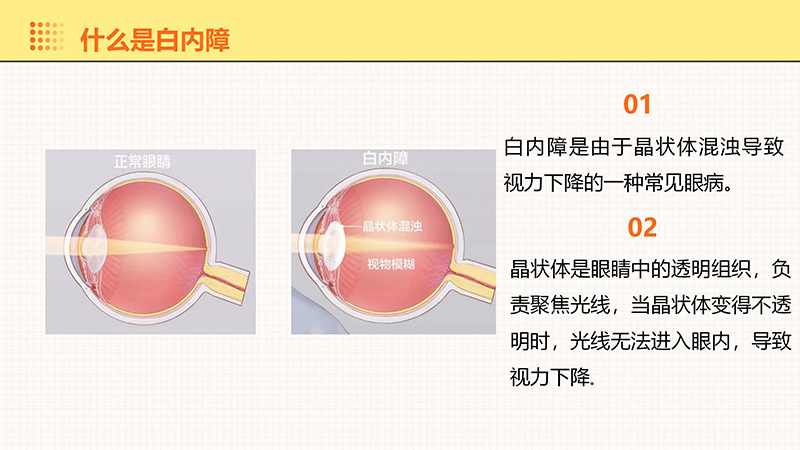 白内障的健康宣教_04.jpg