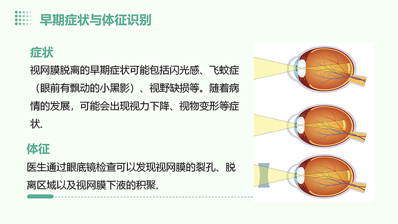 视网膜脱离的健康宣教.pptx(1)_06.jpg